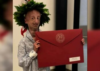 Ιταλία: Πέθανε ο Σάμι Μπάσο, ο άνδρας που έζησε περισσότερο από κάθε άλλο ασθενή με το σύνδρομο της προγηρίας