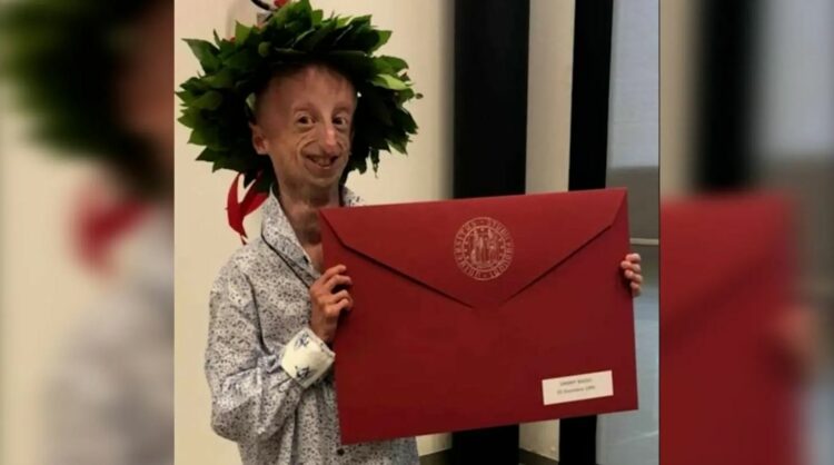 Ιταλία: Πέθανε ο Σάμι Μπάσο, ο άνδρας που έζησε περισσότερο από κάθε άλλο ασθενή με το σύνδρομο της προγηρίας