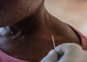 Σε συναγερμό η Γκάμπια μετά τον εντοπισμό κρούσματος της mpox