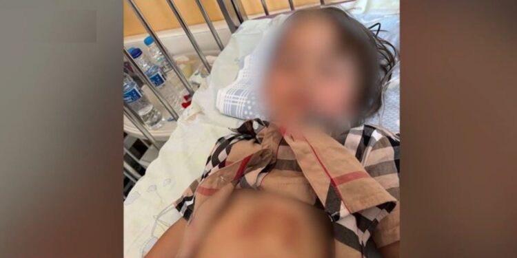 Χαλκιδική: Σοκάρουν τα τραύματα της μικρής που δαγκώθηκε από λύκο